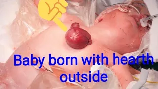 Baby born with her heart outside the body-venellope Wilkins