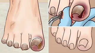 ASMR Athlete's foot treatment animation |Satisfying Video l Ingrown Toenail Removal..