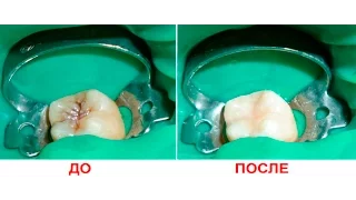 Лечение кариеса зуба