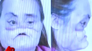 U.S. Face Transplant Appears for First Time