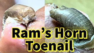 Ram's Horn Toenail: Severe Fungal Toenail