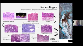 3. Назаров В.Е. Скрининг предраковых поражений желудка.