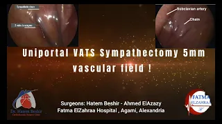 Needle-Scopic Uniportal VATS Sympathectomy 5mm - Vascular field