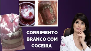 CORRIMENTO BRANCO E COCEIRA / DRA ROBERTA GOMES