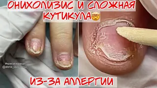 Onycholysis due to allergies 🤬 Sticky, complex cuticle 🥴