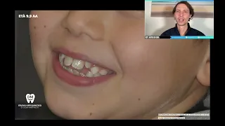 ALLINEARE I DENTI E CHIUDERE IL MORSO CON GLI ALLINEATORI TRASPARENTI NEL BAMBINO DEGLUTIZIONE ok!