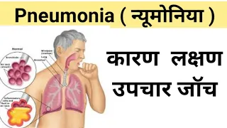 Pneumonia in hindi | pneumonia ke lakshan | निमोनिया के लक्षण और उपाय | pneumonia in covid 19