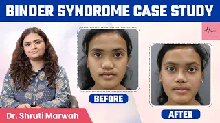 ✅Binder Syndrome Case Study | Before and After Results | ✅Rhinoplasty | Handa Aesthteics, Delhi