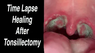 Tonsillectomy Time Lapse Healing Day by Day From Day 0 - Day 25