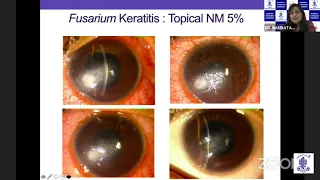 AIOS ARC - Cornea Update Series -Dr.Namrata Sharma