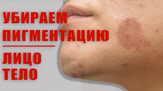 Убираем пигментацию эффективно и безопасно!