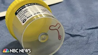 Surgeon extracts live worm from patient's brain