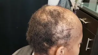 Alopecia Sufferer gets beautiful transformation!