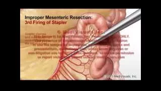 Mechanism of Injury – Laparoscopic Abdominal Surgery