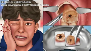 ASMR Wisdom Tooth & Cavity Treatment Animation (Full Ver.) | Teeth Whitening