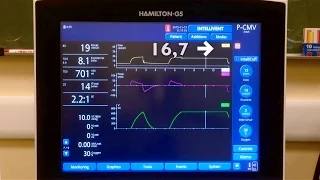 Compliance measurement during pressure control ventilation