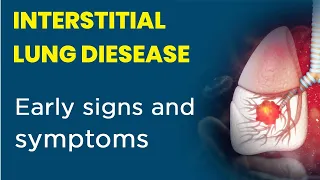 INTERSTITIAL LUNG DISEASE (Hindi) | TYPES OF ILD AND IT'S SYMPTOMS | CURE91