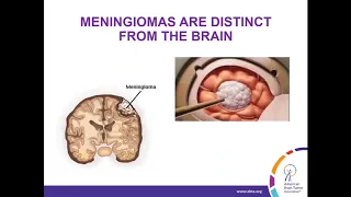 WEBINAR: Treatment Strategies for Meningioma