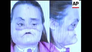 The Cleveland Clinic is holding a limited press briefing with the woman who had a face transplant th