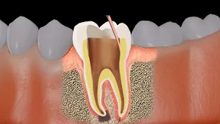 Root canal treatment (RCT) Procedure animation