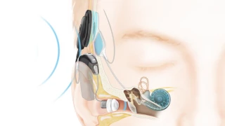 How Cochlear™ hearing solutions work: Nucleus® Hybrid™ System