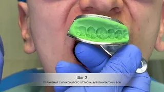 Реставрация бокового зуба без финального пришлифовывания по окклюзии.