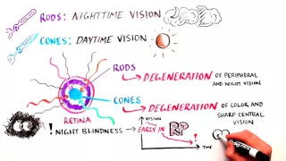 White Board: Retinitis Pigmentosa (RP)