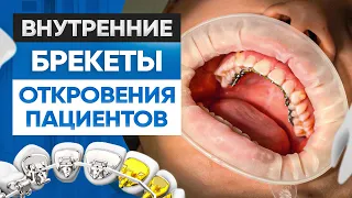 Внутренние брекеты. Откровения и отзывы пациентов клиники OrthoLike