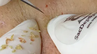 Blackheads Extractions | Lấy Mụn Đầu Đen Dễ Dàng - SacDepSpa#216