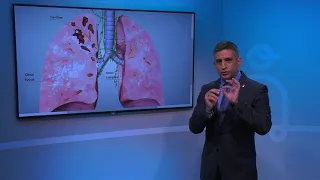 Effects of Tuberculosis on Lungs