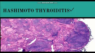 Hashimoto's Thyroiditis : Pathogenesis,Morphology & Clinical features