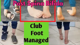 Club Foot post Spina bifida || Before and After treating club foot by Dr. Khaqan Jahangir Janjua