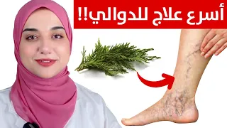 وصفة رائعة للتخلص من الدوالي و الاورده العنكبوتية في الساقين في ايام ...