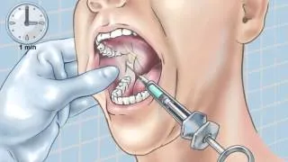 Standard Inferior Alveolar Nerve Block