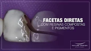 Facetas Diretas com Resinas Compostas e Pigmentos | Leonardo Muniz