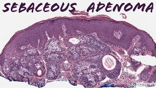 Sebaceous Adenoma: 5-Minute Pathology Pearls