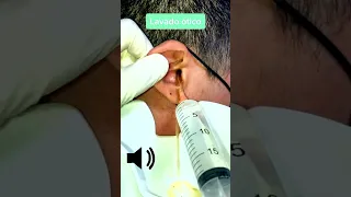 Blackheads and milia big cystic acne blackheads extraction - Newest pimple popping this week