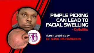 Pimple Picking can lead to facial swelling - cellulitis