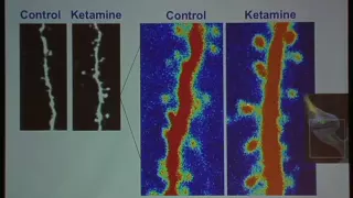 New Mechanisms Elicited with Ketamine in Treatment-Resistant Depression