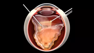 Retinal Detachment | Signs, Symptoms and Treatment