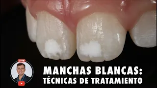 Manchas blancas: Técnicas de tratamiento