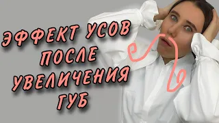 МИГРИРОВАЛ ФИЛЛЕР/ГИАЛУРОНКА ЗА КОНТУР ГУБ/ГЕЛЬ МИГРИРУЕТ ПОСЛЕ УВЕЛИЧЕНЯ ГУБ.