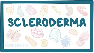 Scleroderma - an Osmosis Preview