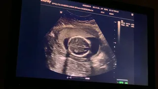 [19 Weeks Pregnant] Gender Reveal Sonogram Anatomy Scan Doctor Appointment