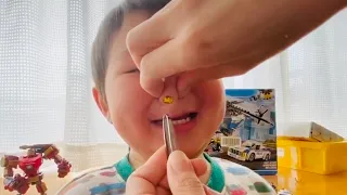 LEGO STUCK IN HIS NOSE!!!