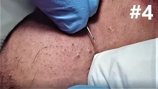 BIG BLACKHEADS EXTRACTIONS on Happy :) #4