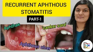 RECURRENT APHTHOUS STOMATITIS (RAS) PART-1