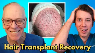How to Recover From a Hair Transplant
