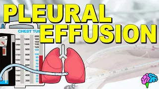 What is a Pleural Effusion? EXPLAINED!