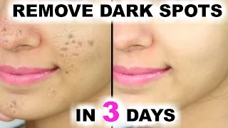 In 3 DAYS - Remove DARK SPOTS, BLACK SPOTS & ACNE SCARS | Anaysa